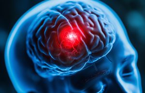 image of a brain showing brain bleed